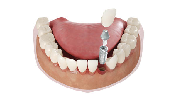 What Foods Are Friendly To Dental Implants?