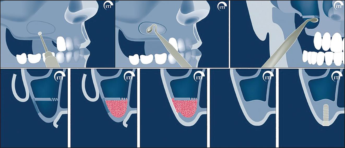 Bone Grafting