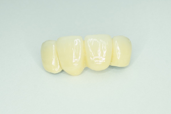 Understanding The Process For Dental Bridges