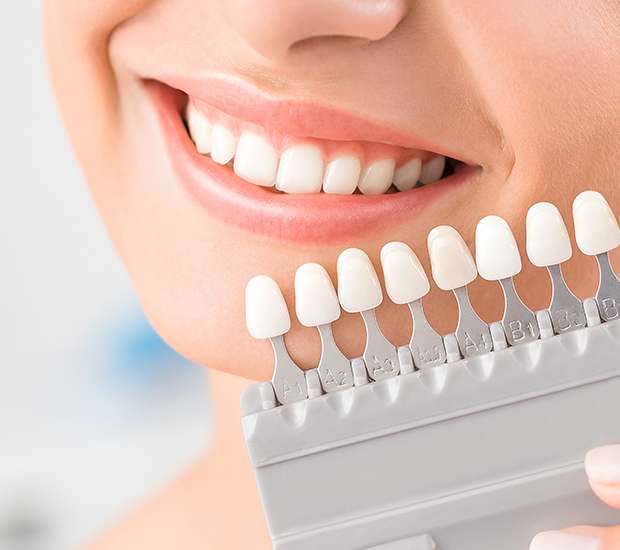 Carpinteria Dental Veneers and Dental Laminates