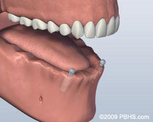 Ball Attachment Denture Implants Placed