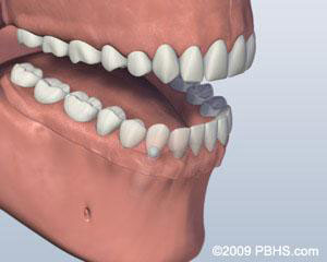 Ball Attachment Denture Denture Attached=