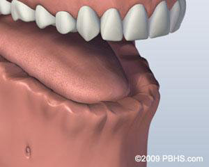 Bar Attachment Denture / Overdenture Before