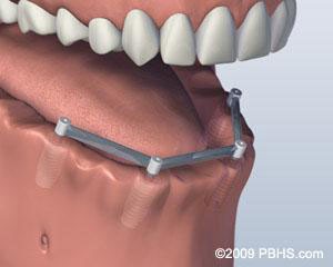 Bar Attachment Denture / Overdenture Implants Placed