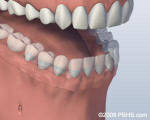 Bar Attachment Denture / Overdenture Dentures Attached