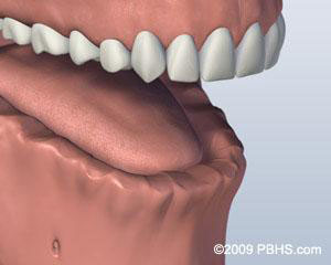 Screw Retained Denture Before