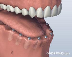 Screw Retained Denture Implants Placed
