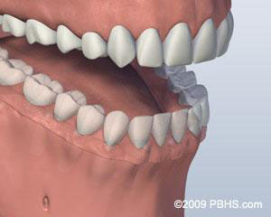 Screw Retained Denture Denture Attached