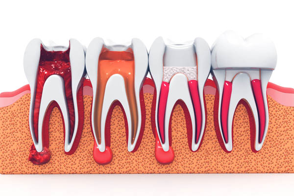 Common Dental Restorations After Root Canal Therapy